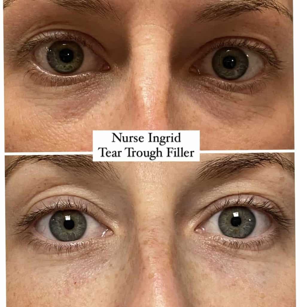 A close-up of dermal fillers being applied to smooth wrinkles