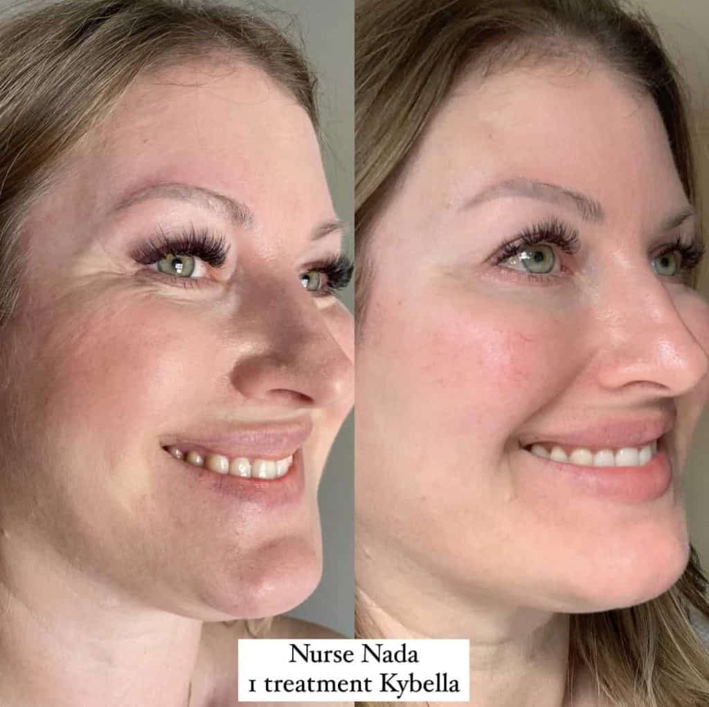 Before-and-after results of Kybella fat dissolving in Oakville, showing a refined jawline.